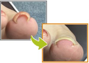 ふなき接骨院巻き爪9