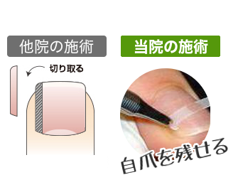 ふなき接骨院巻き爪14